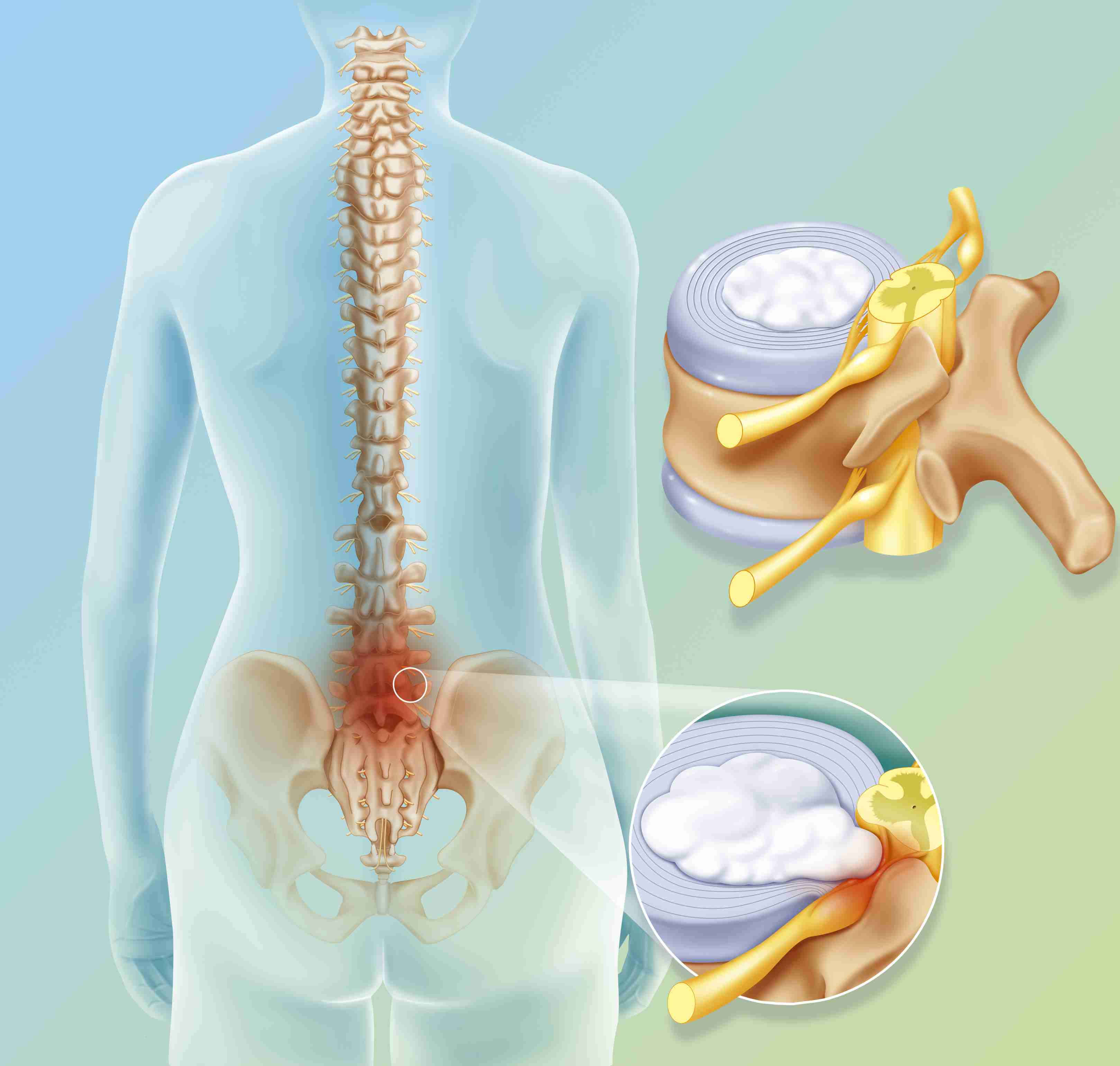 herniated disc in lumber