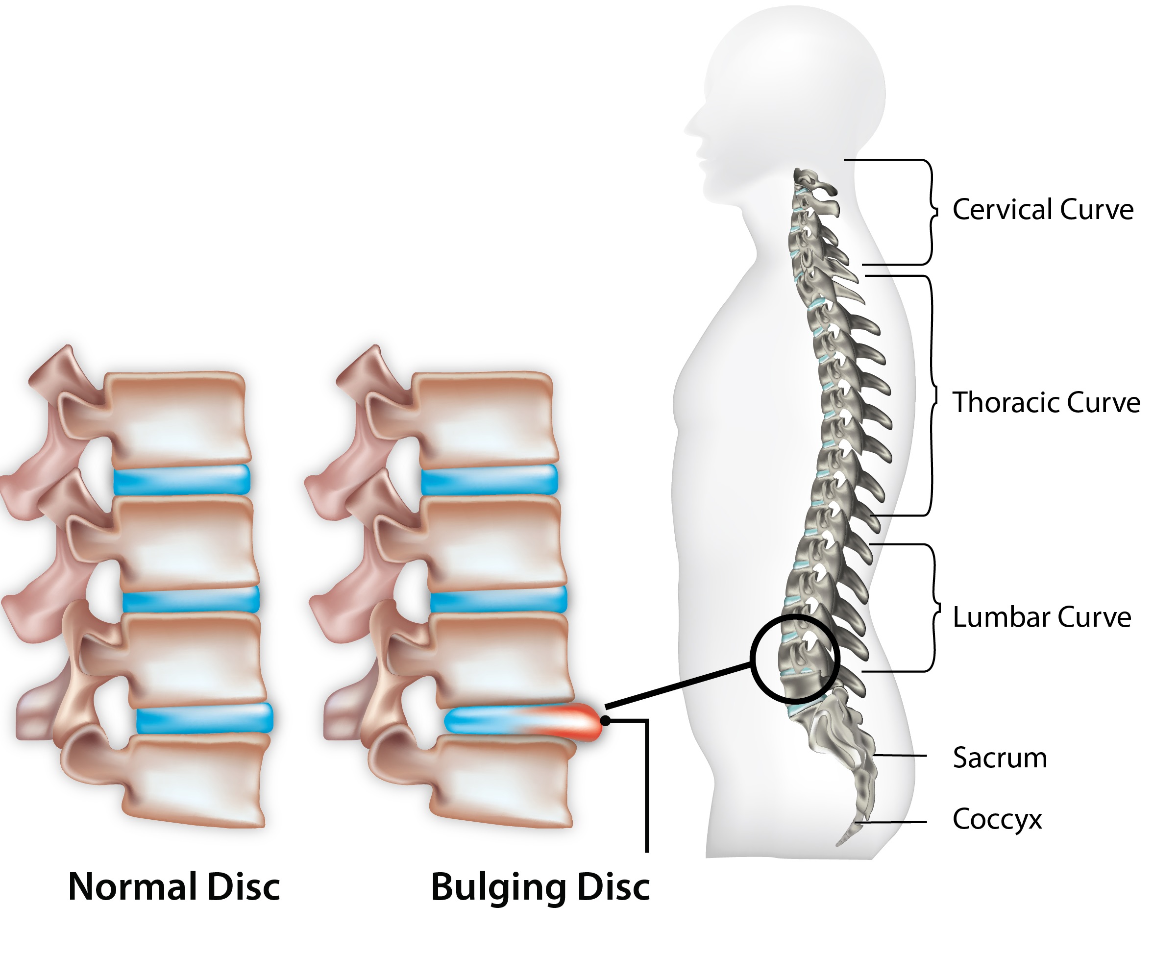 herniated disc