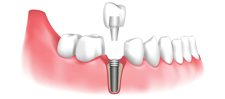 Dentures Implant