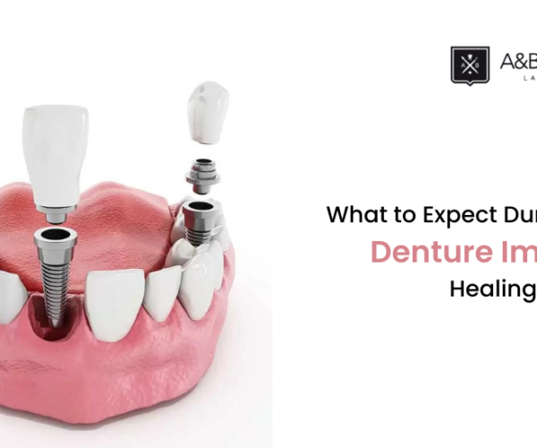 What to Expect During the Denture Implant Healing Stages